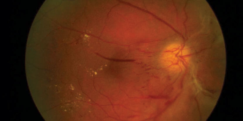 diabetic retinopath