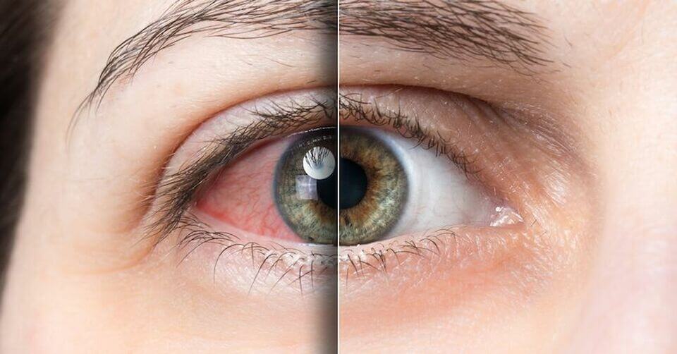 Dry eye and light sensitivity photophobia