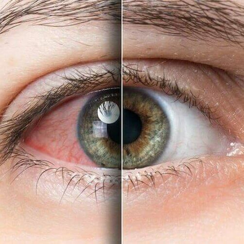 Dry eye and light sensitivity photophobia